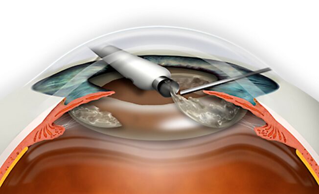 The refractive exchange of the lens is carried out by micronadle, the blood loss excludes