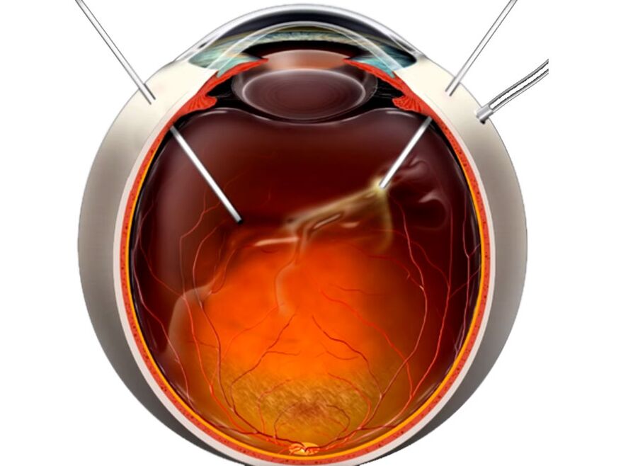 Vitrectomy - a process that is shown in retina peeling